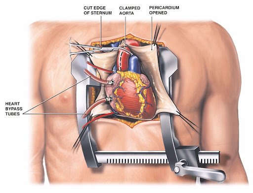 Heart Valve Surgery at Yashroop Hospital Gurgaon