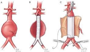 Aortic Surgery