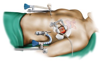 Beating Heart Surgery