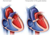 Congenital Heart Surgery