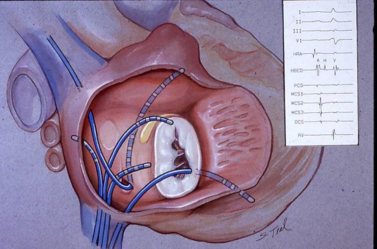 Electrophysiology Study