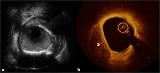 IVUS and OCT Imaging