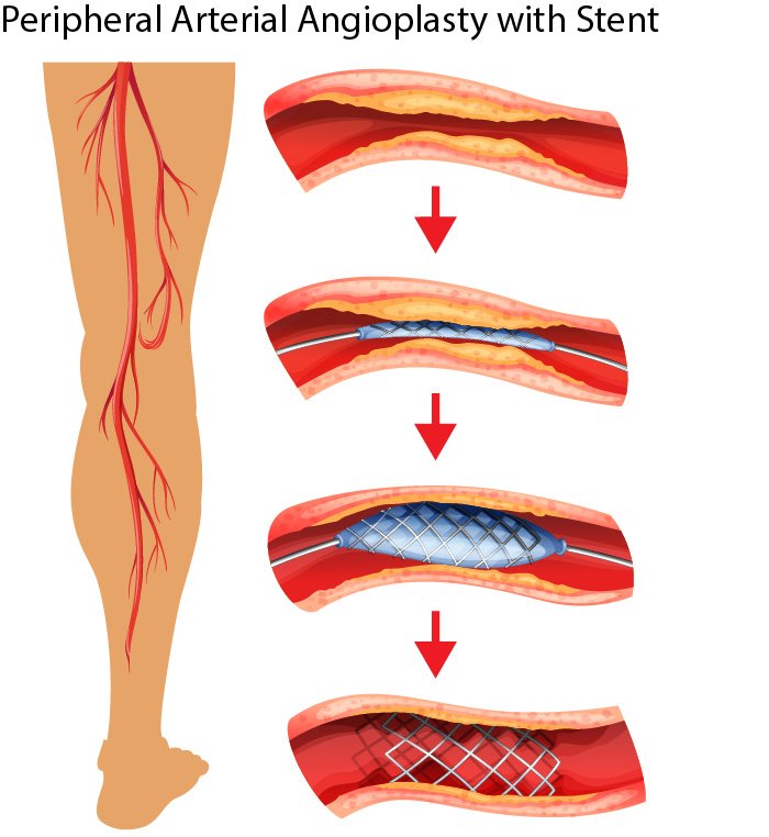 Peripheral Angioplasty
