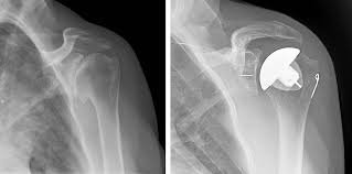 Shoulder Replacement Surgery