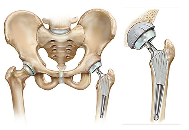 Total Hip Replacement Surgery