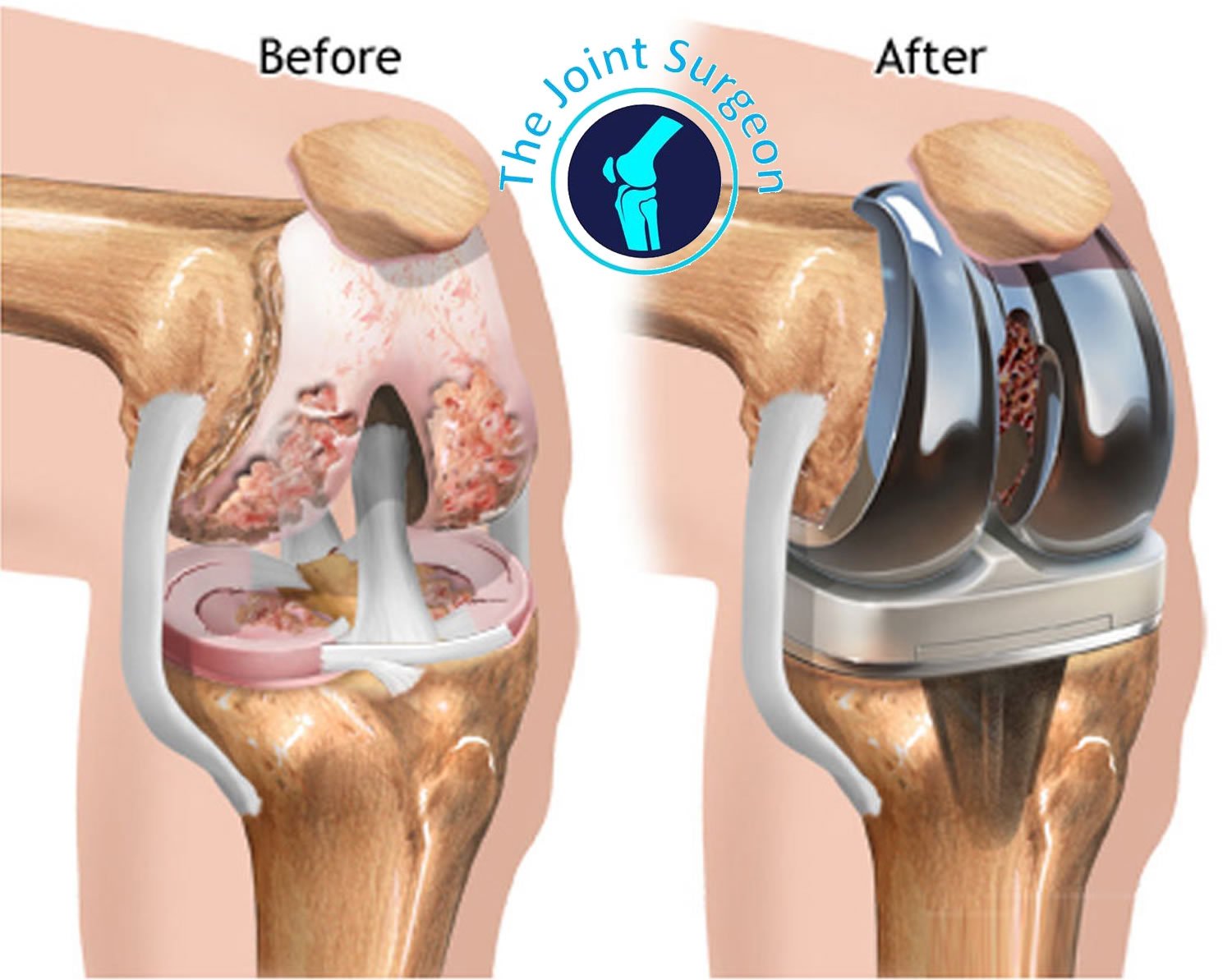 Total Knee Replacement Surgery
